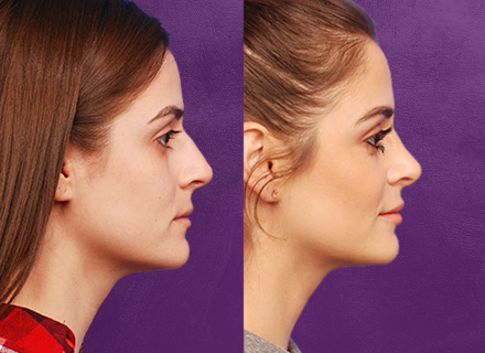 Profile comparison of two women against purple background.
